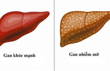 GAN NHIỄM MỠ