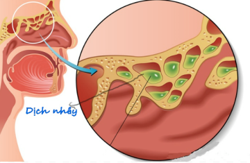 6 biện pháp tự nhiên điều trị nghẹt mũi