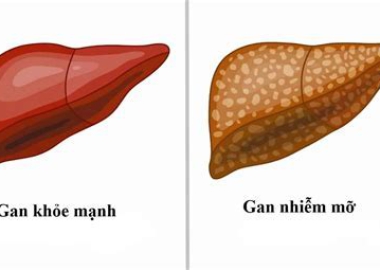 GAN NHIỄM MỠ